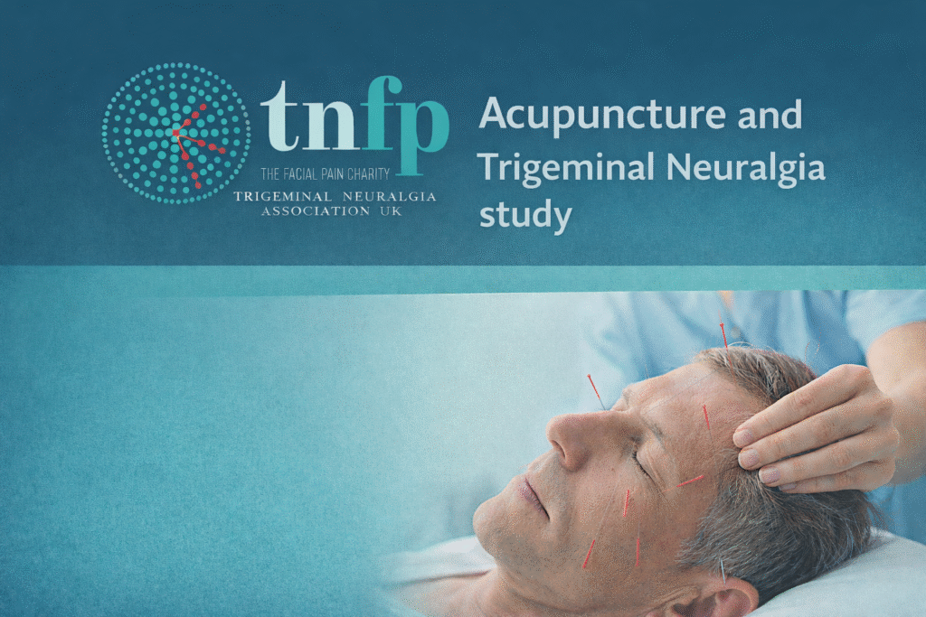 Acupuncture and Trigeminal Neuralgia Study